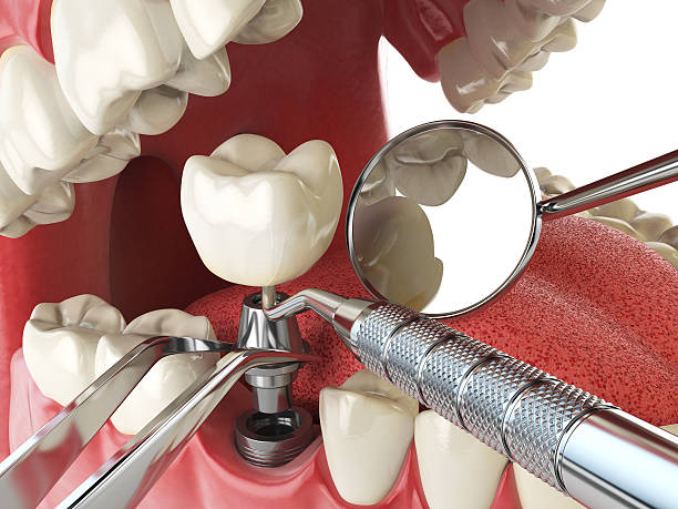 Best Emergency Dentist for Lost Fillings or Crowns in Monticello, FL